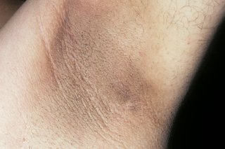 بیماری پوستی آکانتوزیس نیگریکانس
