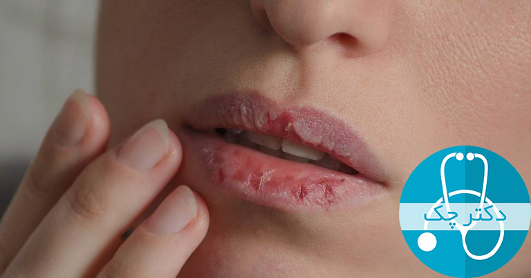 علائم خشکی دهان چیست؟