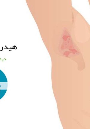 درمان گیاهی هیدرآدنیت چرکی