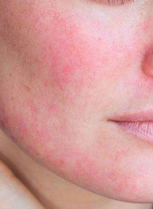 داروهای خانگی برای درمان قرمزی پوست صورت + نکاتی برای پیشگیری