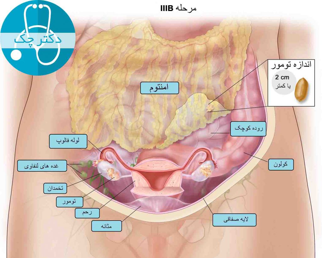 مرحله 3 Ovarian cancer