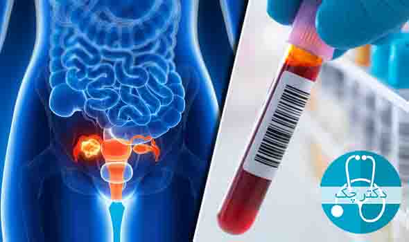 آزمایش خون برای تشخیص Ovarian cancer