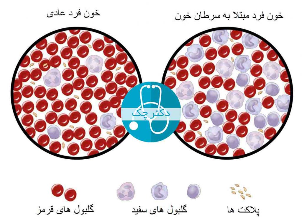 علت های ابتلا به سرطان خون