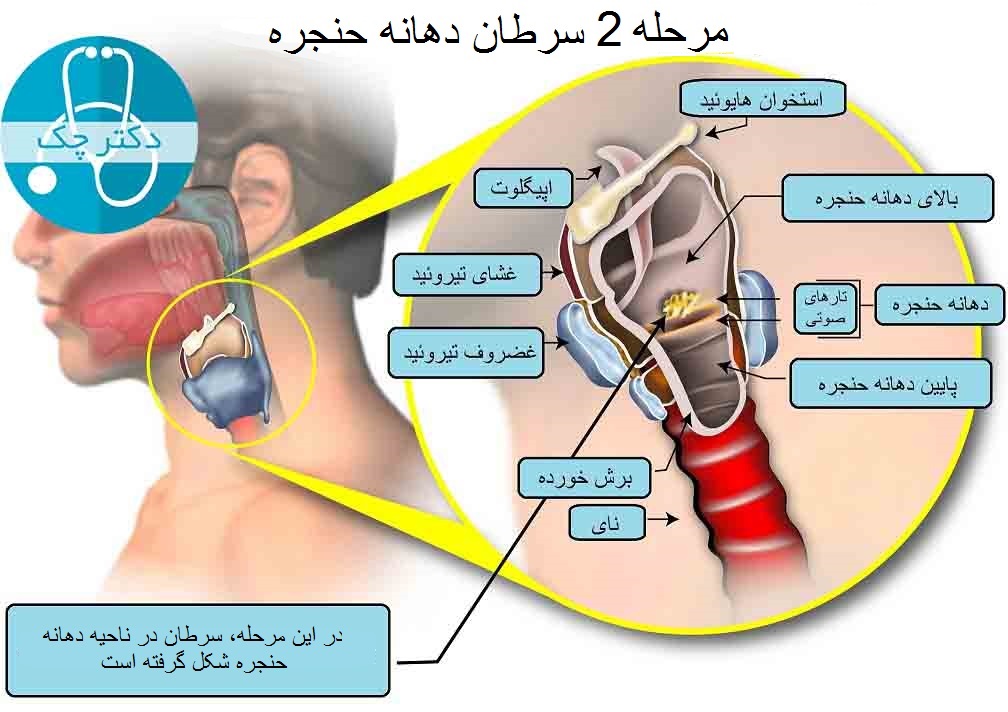 مرحله 2 سرطان دهانه حنجره