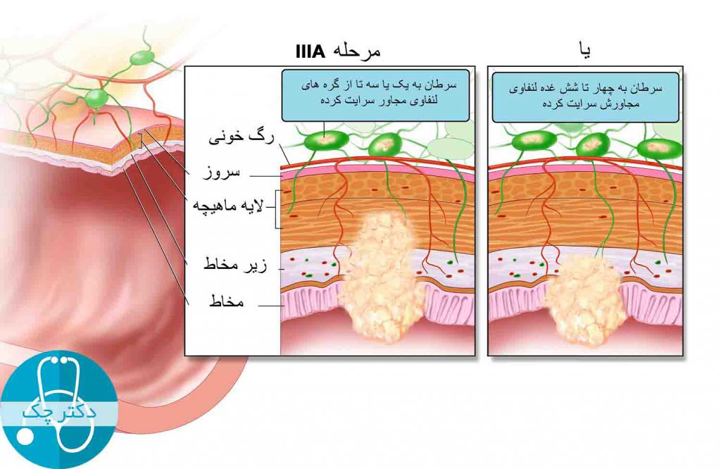 مرحله IIIA سرطان روده بزرگ