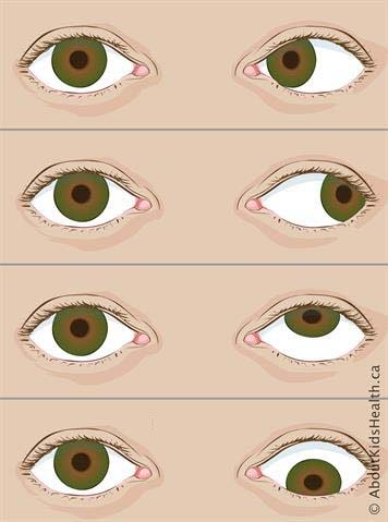 انواع چپ چشمی