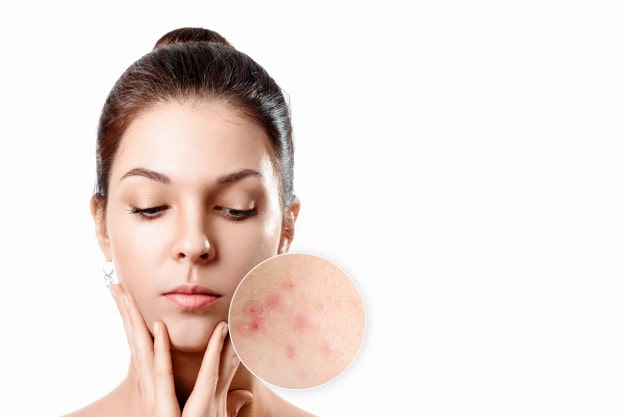 young-woman-with-acne-skin-zoom-circle-y