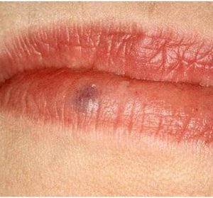 لکه های تیره روی لب و گوشه لب