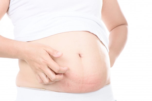 درمان خارش بدن در بارداری