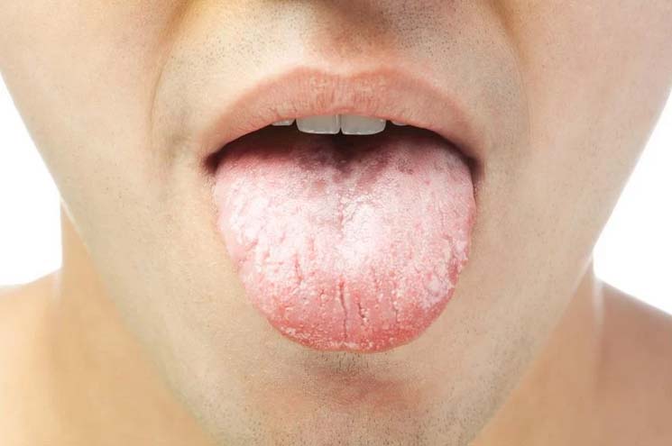 درمان سفیدی زبان در خانه