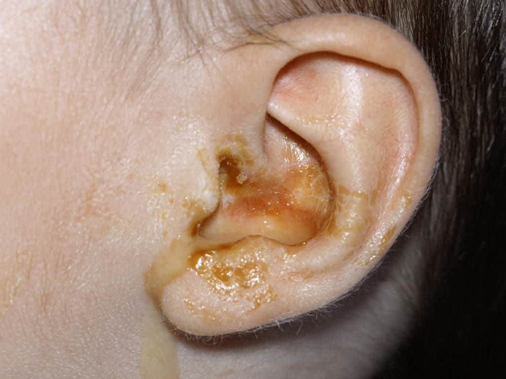 درمان ترشحات زرد گوش