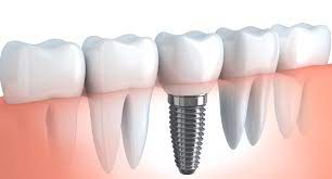 روش های انجام ایمپلنت دندان؟
