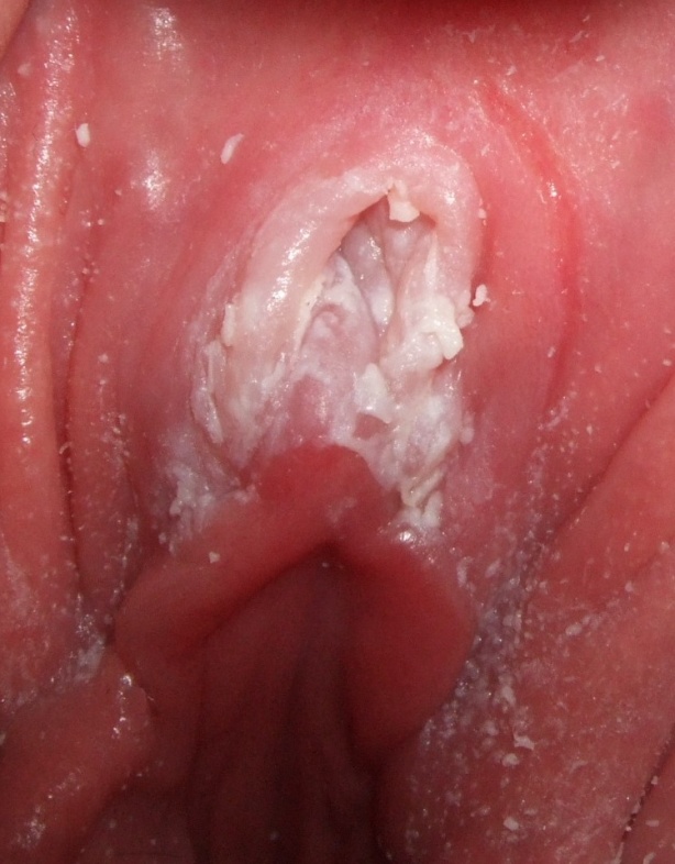 عکس قارچ پوستی در ناحیه تناسلی زنان