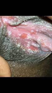 عکس عفونت قارچی واژن
