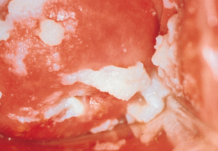 عکس عفونت ناحیه تناسلی زنان