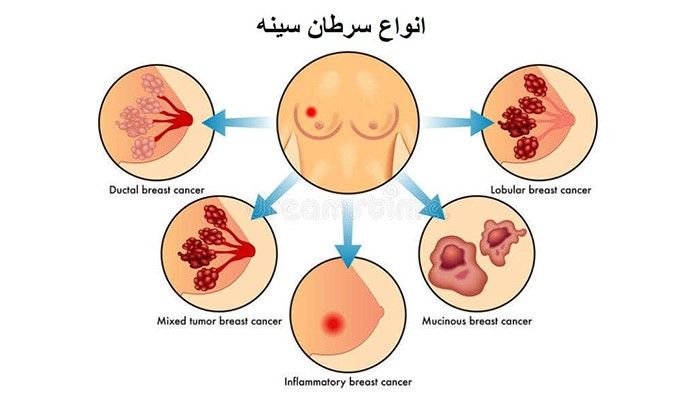 درمان سرطان پستان