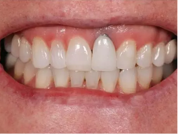  ایمپلنت دندان