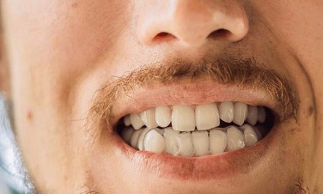 ناهنجاری اکلوژن دندان‌ها از عوارض نداشتن دندان