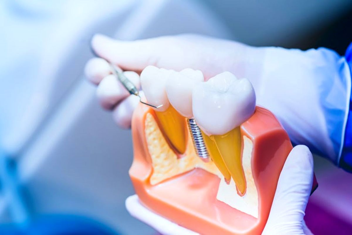 ​ایمپلنت دندان کره‌ای چه مزایایی دارد؟