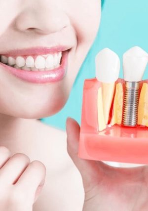 آیا ایمپلنت دندان مادام العمر است؟