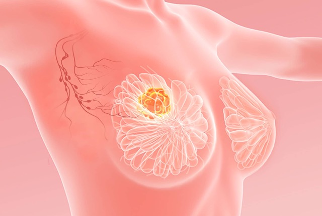 فاکتورهای خطر برای ابتلا به سرطان سینه در بانوان