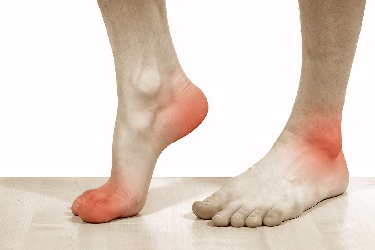گزینه های درمانی برای نقرس مچ پا