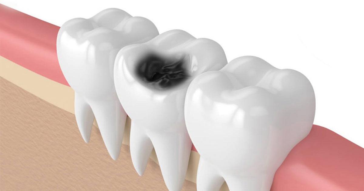 عصب کشی؛ راهی برای حفظ سلامت دندان‌ها