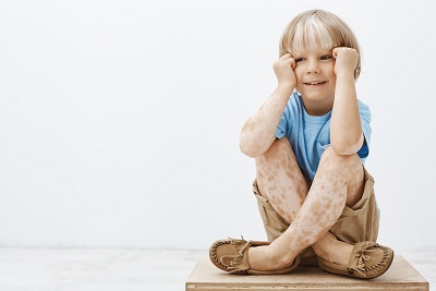 درماتیت آتوپیک در کودکی؛ عوارض کمبود ویتامین D در کودکان