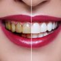 لمینیت دندان بهتر است یا کامپوزیت؟ چرا؟