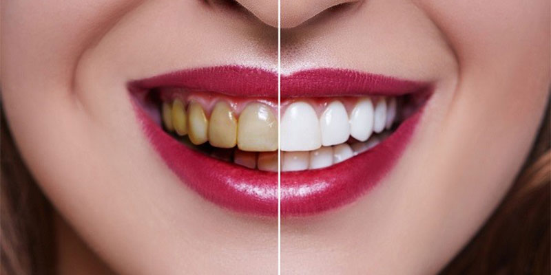 لمینیت دندان بهتر است یا کامپوزیت؟ چرا؟