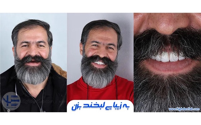 بهترین مارک‌های دندان مصنوعی کدامند؟