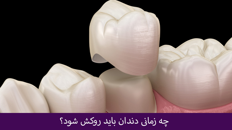 چه زمانی دندان باید روکش شود