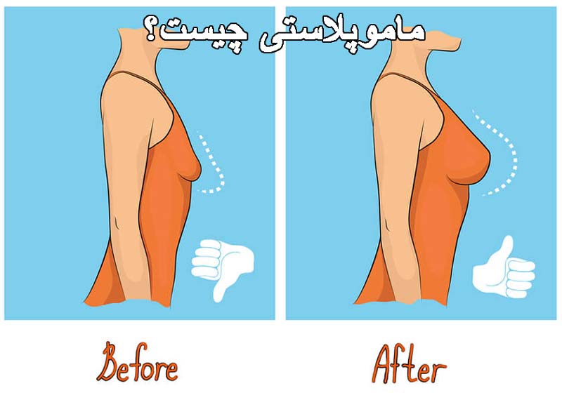 مراحل انجام عمل ماموپلاستی چگونه است؟