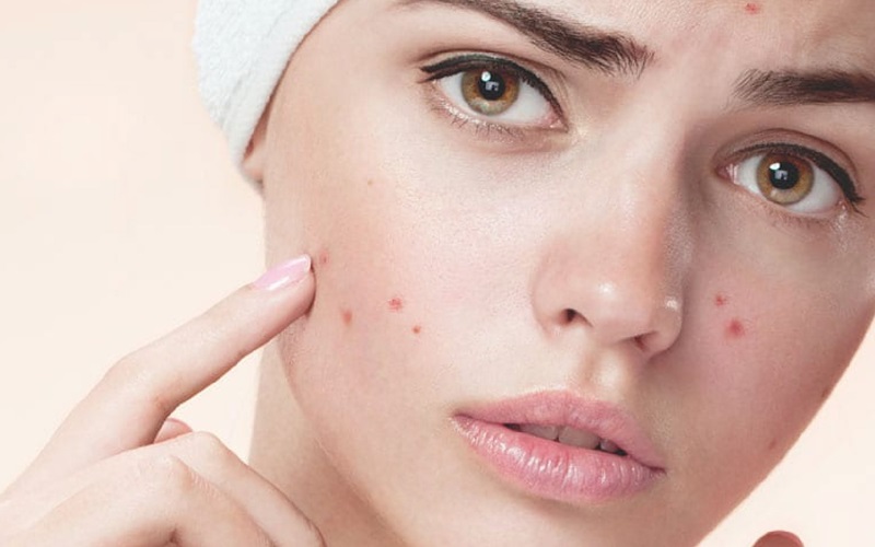 درمان جوش صورت با بهترین روش های خانگی