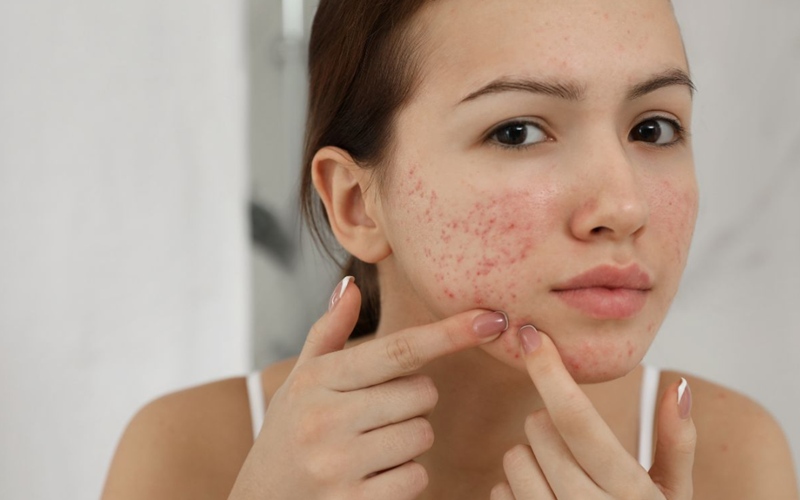 درمان خانگی جوش صورت