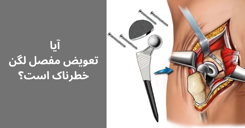 تشکیل لخته خون از خطرات تعویض مفصل لگن است