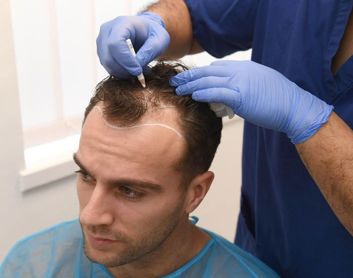 معرفی تکنیک کاشت مو SUT