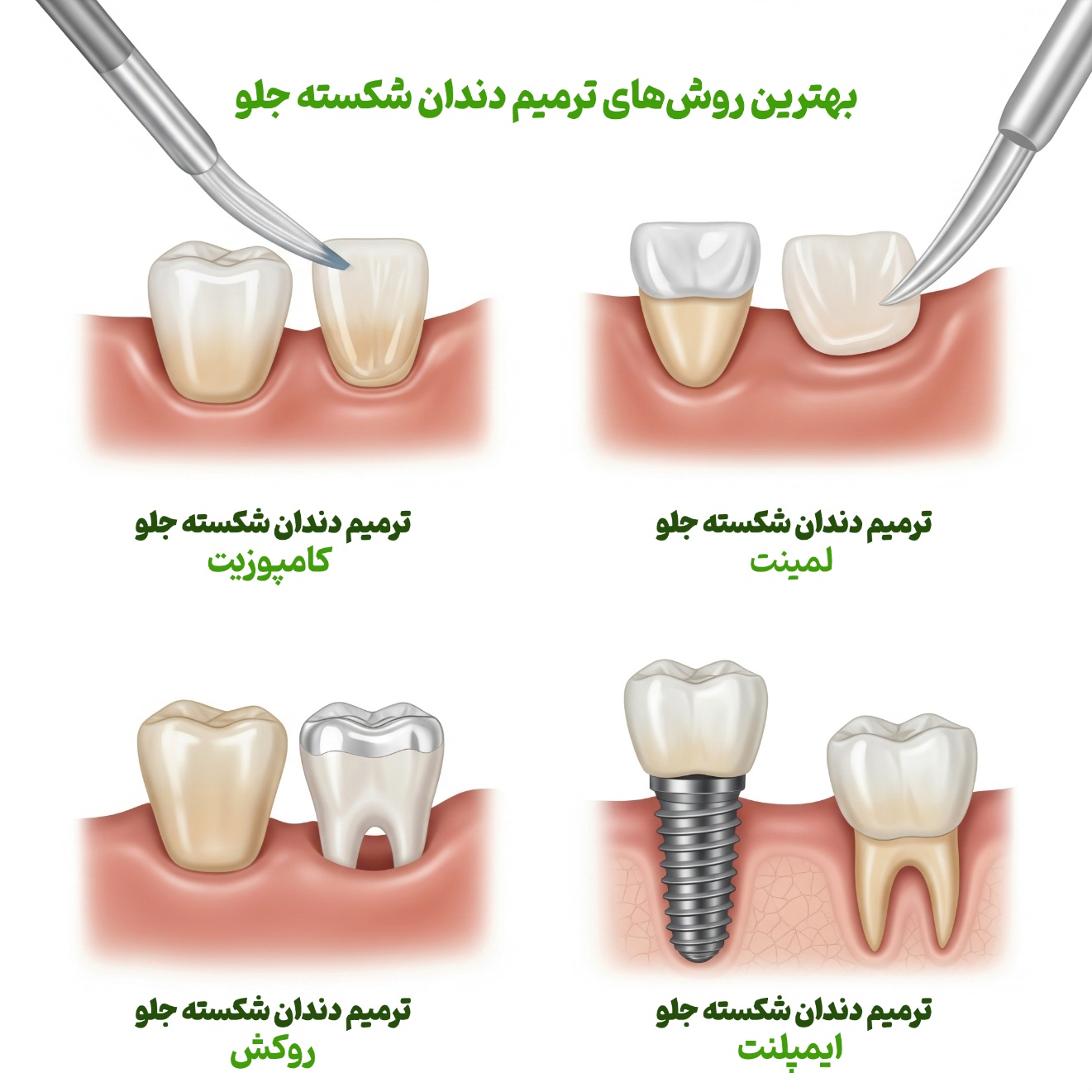 بهترین روش ترمیم دندان شکسته جلو