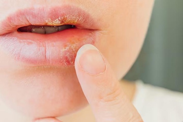 کمبود چه ویتامینی باعث تبخال لب میشود