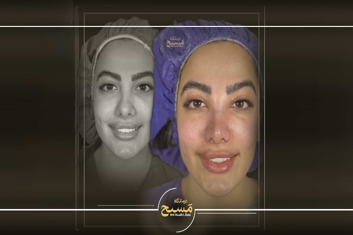 چگونه بهترین دکتر جراحی بینی گوشتی در تهران را انتخاب کنیم؟