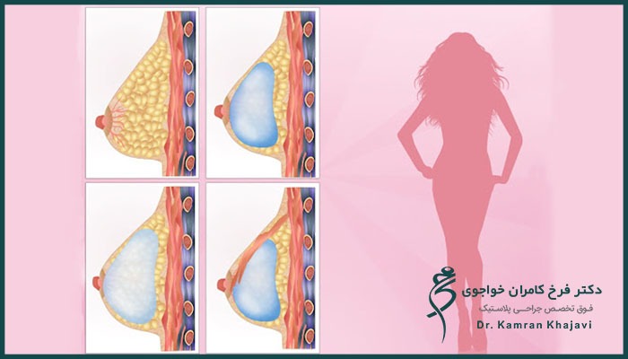افزایش سایز بعد از ماموپلاستی